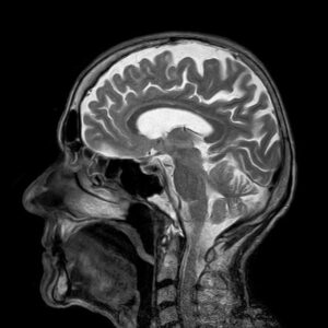 MRI ראש