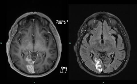 תוצאות MRI מוח