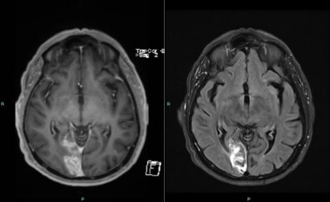 Read more about the article תוצאות MRI מוח