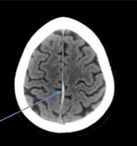 חבלת ראש CT