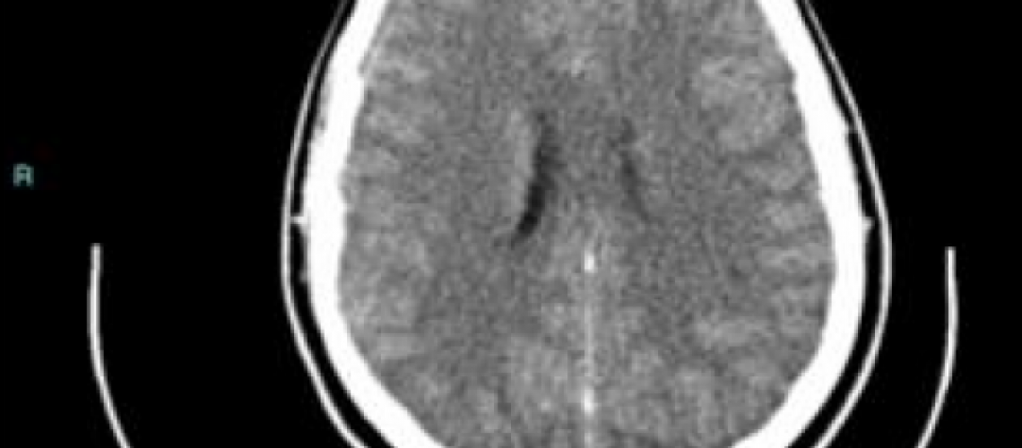 CT-after-first-epileptic-seizure-34je37m5ukz9fqtc7p6k22
