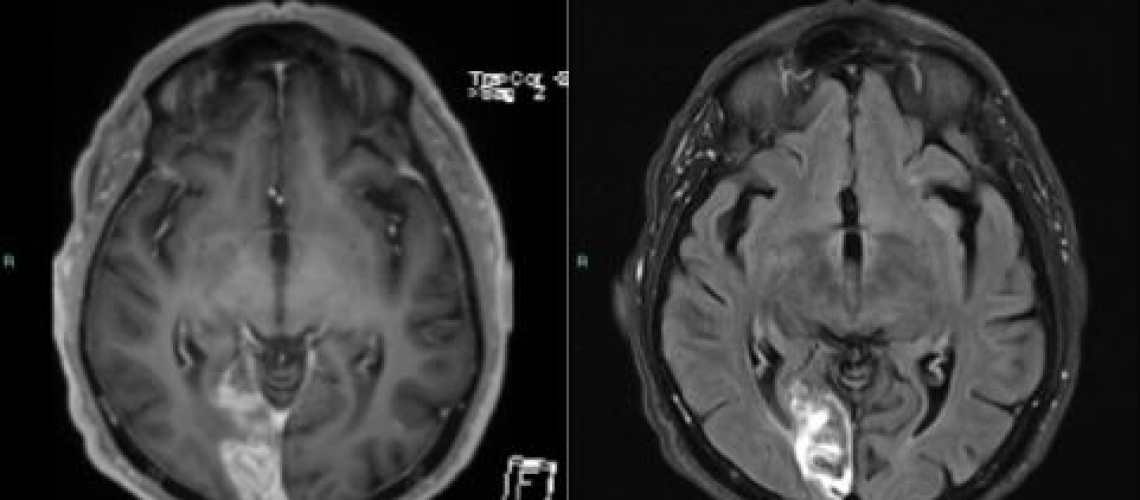 תוצאות MRI מוח