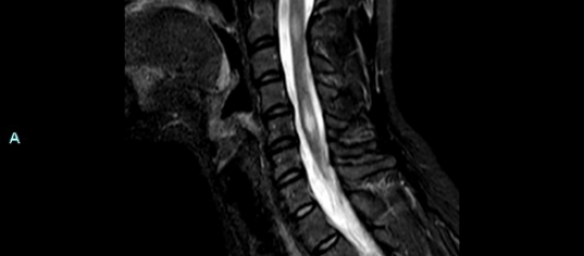Scan-of-cervical-spine-340zywptllqz6433uf1szu