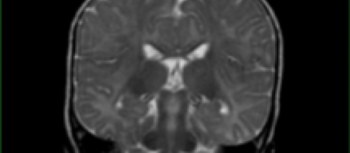 brain-mri-34gc1tkmmm8ahw6yr9xf62