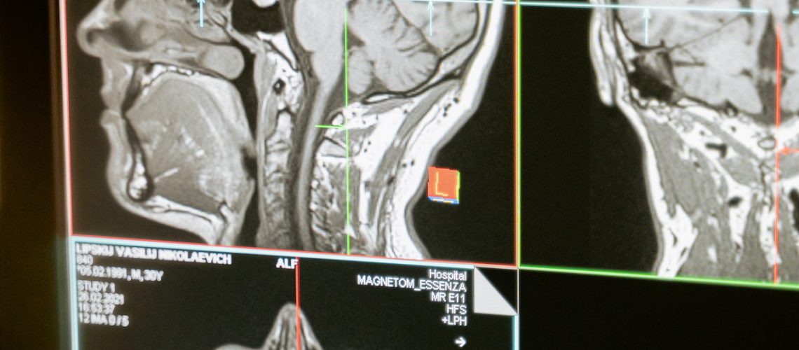 דימות ראש - MRI